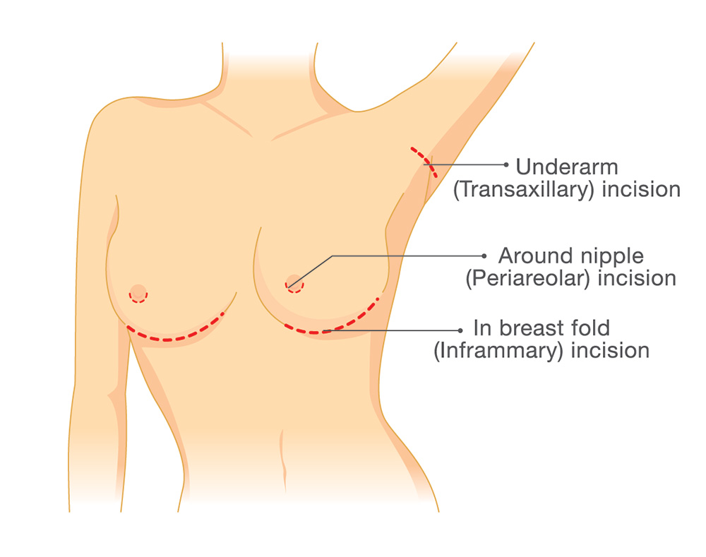 incisiones mamoplastia
